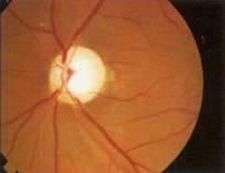 Simptome frecvente ale atrofiei nervului optic