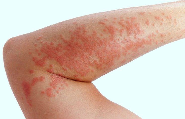 Simptome frecvente ale alergiei cutanate