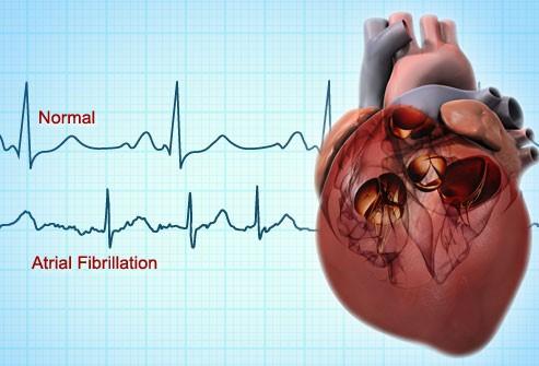 Ce este aritmia cardiacă și de ce contează pentru sănătatea ta
