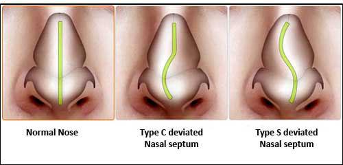 Diagnostic pe scurt al hipertrofiei ganglionare