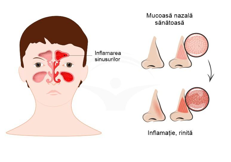 Cauze și factori favorizanți ai rinofaringitei cronice