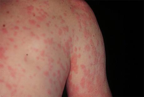 Ce este urticaria cronică