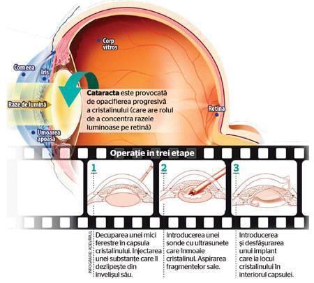 Ce înseamnă hemeralopia
Semne și simptome frecvente ale hemeralopiei
Cauze posibile și factori de risc asociați
Când este recomandat să consulți un specialist
Diagnosticul în linii mari
Opțiuni terapeutice convenționale și rolul managementului medical
Remedii naturale și limitele dovezilor disponibile
Modificări ale stilului de viață și strategii de prevenire