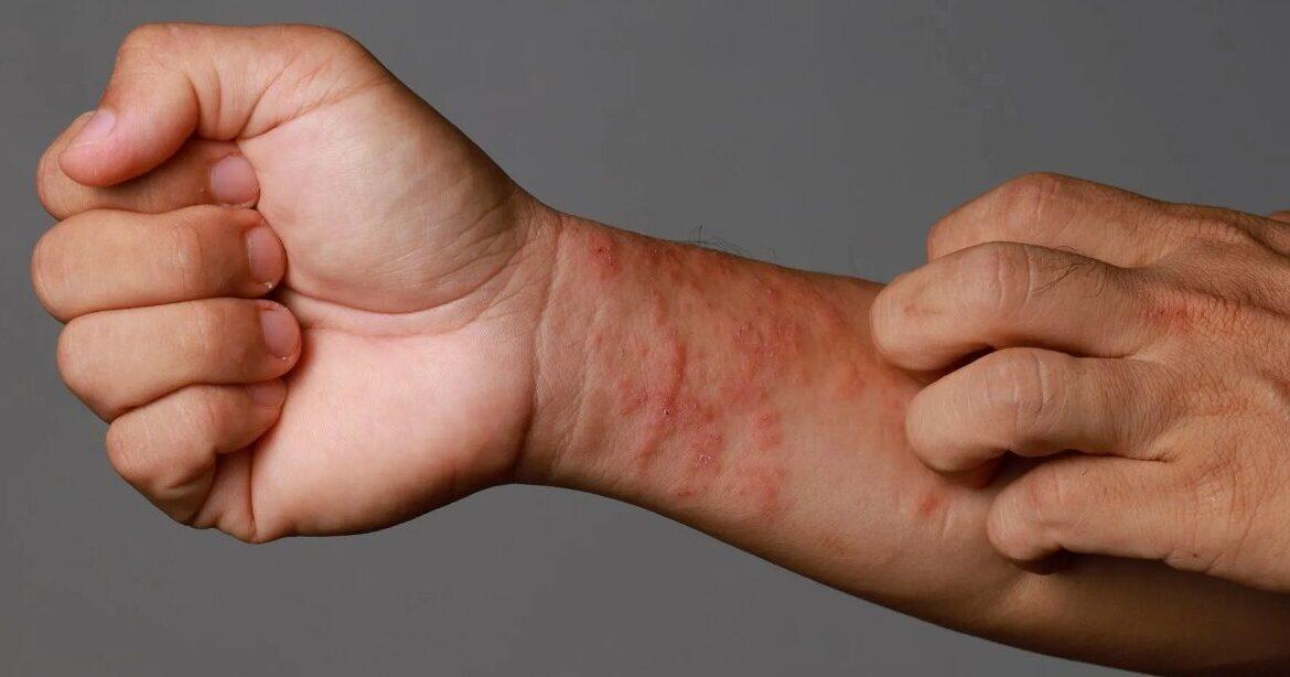 Ce este o dermatoză și cum afectează pielea