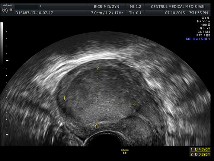 Ce înseamnă un chist ovarian și cum se clasifică
Semne clinice și simptome frecvente pe care le poți observa
Cauze posibile și factori care pot crește riscul
Când este momentul potrivit pentru a consulta medicul
Procesul de diagnostic pe scurt și investigațiile uzuale
Tratamente convenționale opțiuni medicale și intervenții recomandate
Remedii naturiste ce dovezi există și ce precauții sunt importante
Modificări ale stilului de viață care pot susține sănătatea ovariană și prevenția