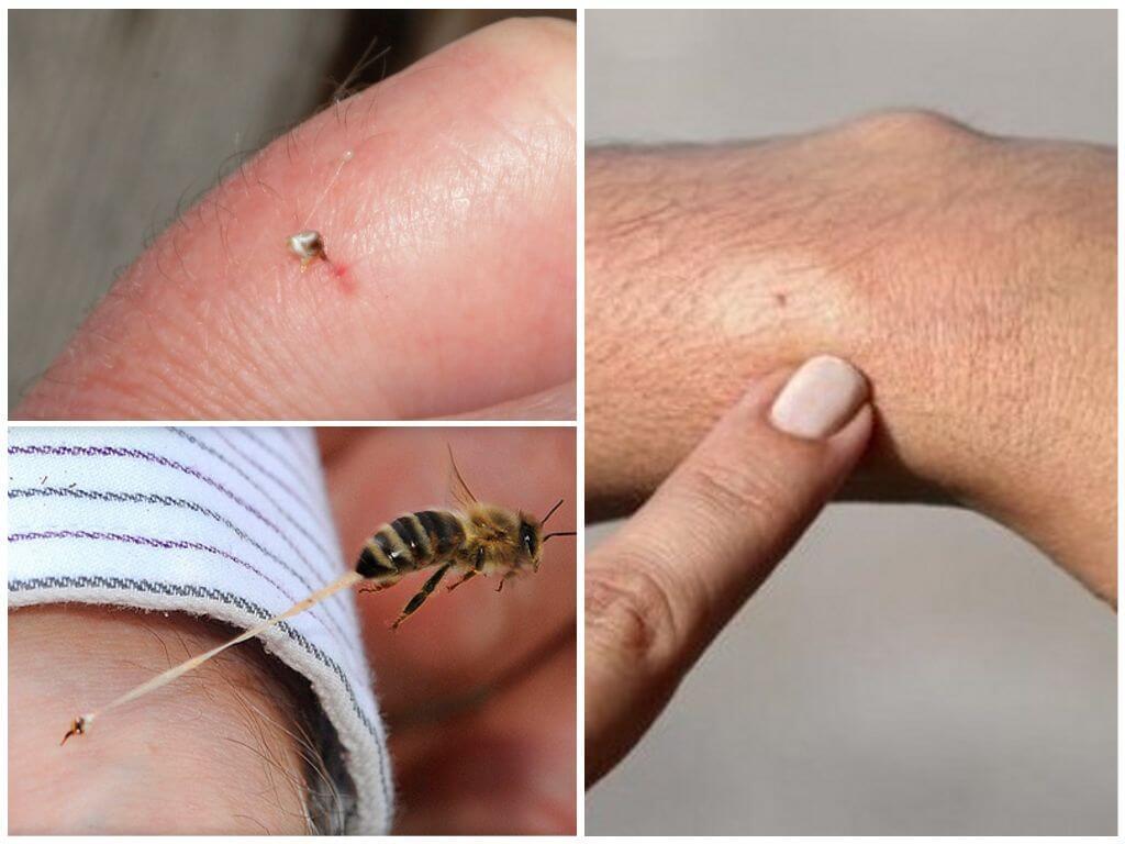 Ce este înțepătura de insecte