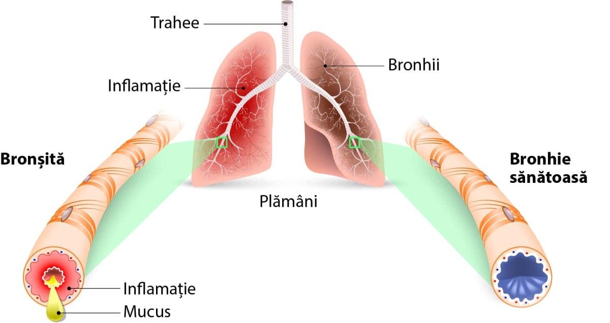 Simptome frecvente ale bronșitei cronice
