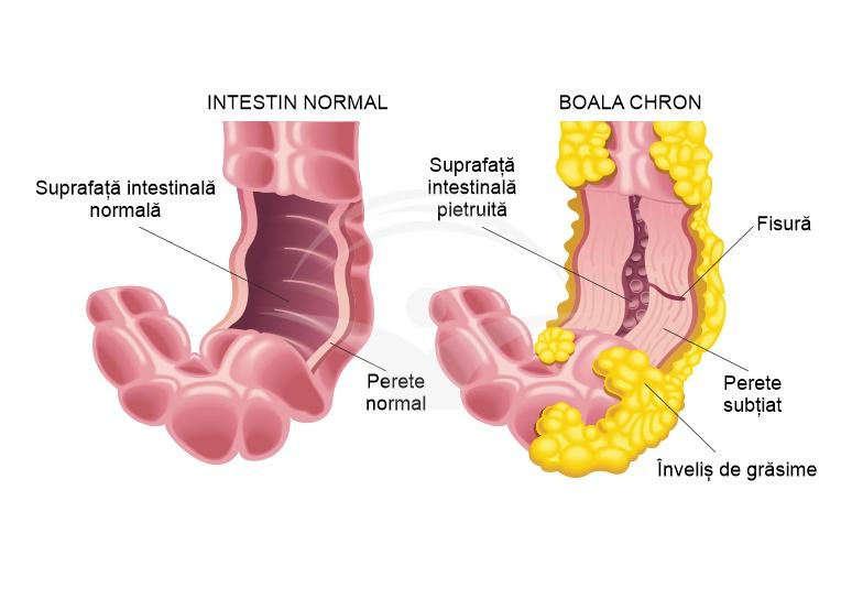 Ce este boala Crohn