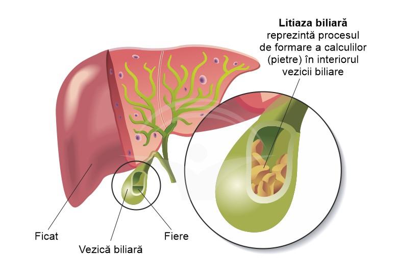 Simptome frecvente ale calculilor biliari