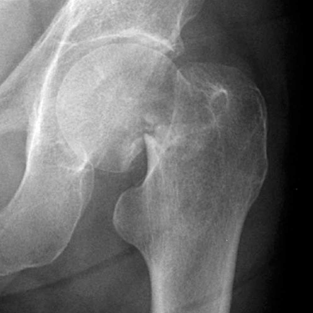 Ce sunt fracturile osoase și cum apar
Semne și simptome frecvente ale fracturilor
Cauze comune și factori care cresc riscul
Semne de alarmă când este necesar să consulți un medic
Evaluare și diagnostic sumar al fracturilor
Tratamente medicale standard și opțiuni chirurgicale
Măsuri naturiste complementare pentru sprijinirea vindecării
Adaptări ale stilului de viață și strategii de prevenire