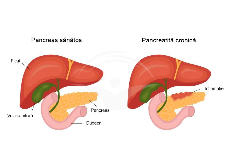 Ce este pancreatita cronică