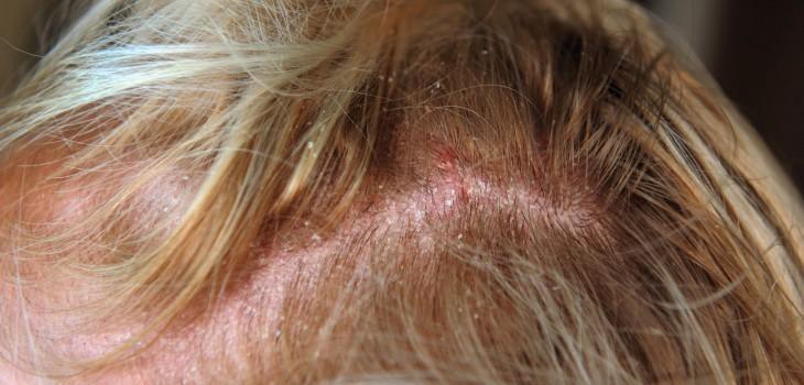 Ce este dermatoza veziculară