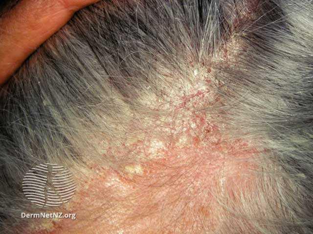 Ce este dermatita seboreică: definiție, localizări şi impact asupra calităţii vieţii