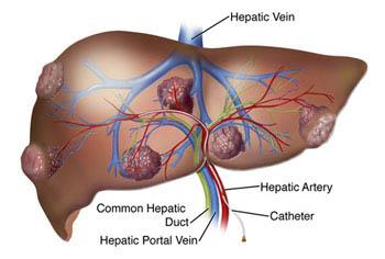 Ce este ciroza hepatică și cum influențează sănătatea
Manifestări frecvente ale cirozei pe care să le recunoști
Cauze frecvente și factori care pot favoriza apariția cirozei
Când este recomandat să consulți un medic specialist în ficat
Diagnostic pe scurt proceduri uzuale și semnificațiile lor
Abordări terapeutice convenționale și obiectivele tratamentului
Remedii naturiste complementare cu precauții și limitările lor
Stil de viață recomandat și măsuri preventive pentru stabilitate hepatică