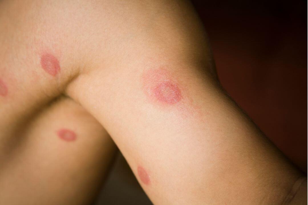 Simptome frecvente ale dermatozei veziculare