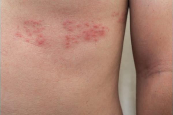 Ce este dermatoza eritematoasă definiție impact și importanța recunoașterii
