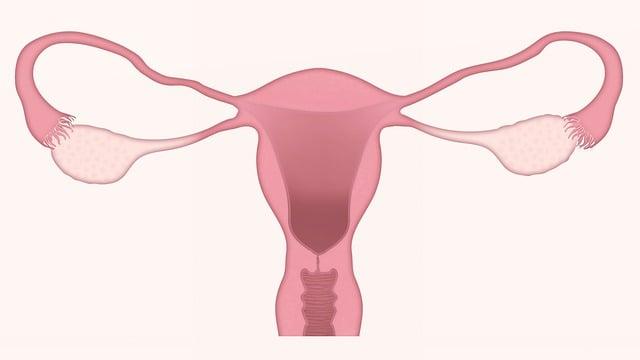 Ce este fibromul uterin