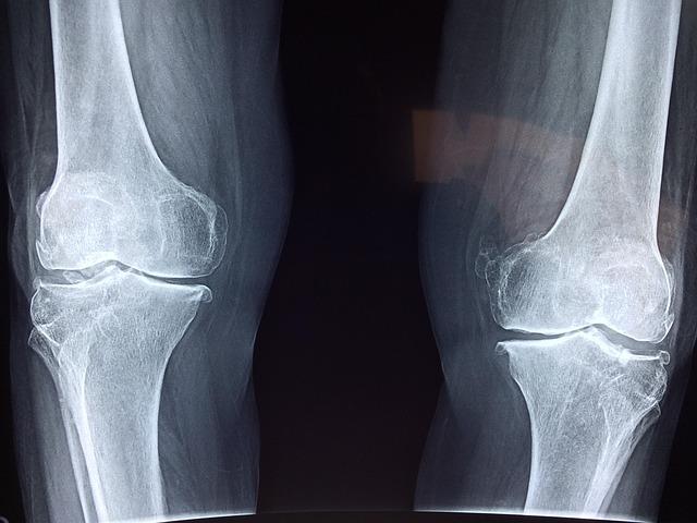 Ce este osteocondrita